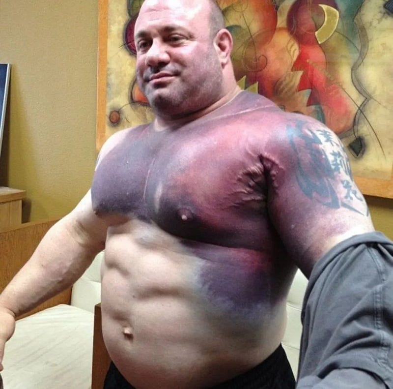 Scott Mendelson's injury during weightlifting