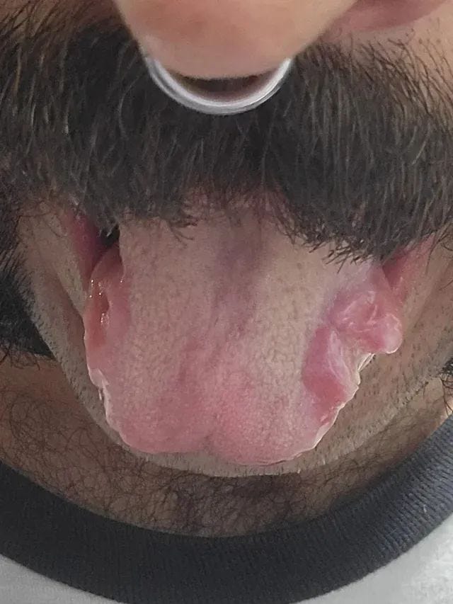 Patient's tongue during an epileptic seizure